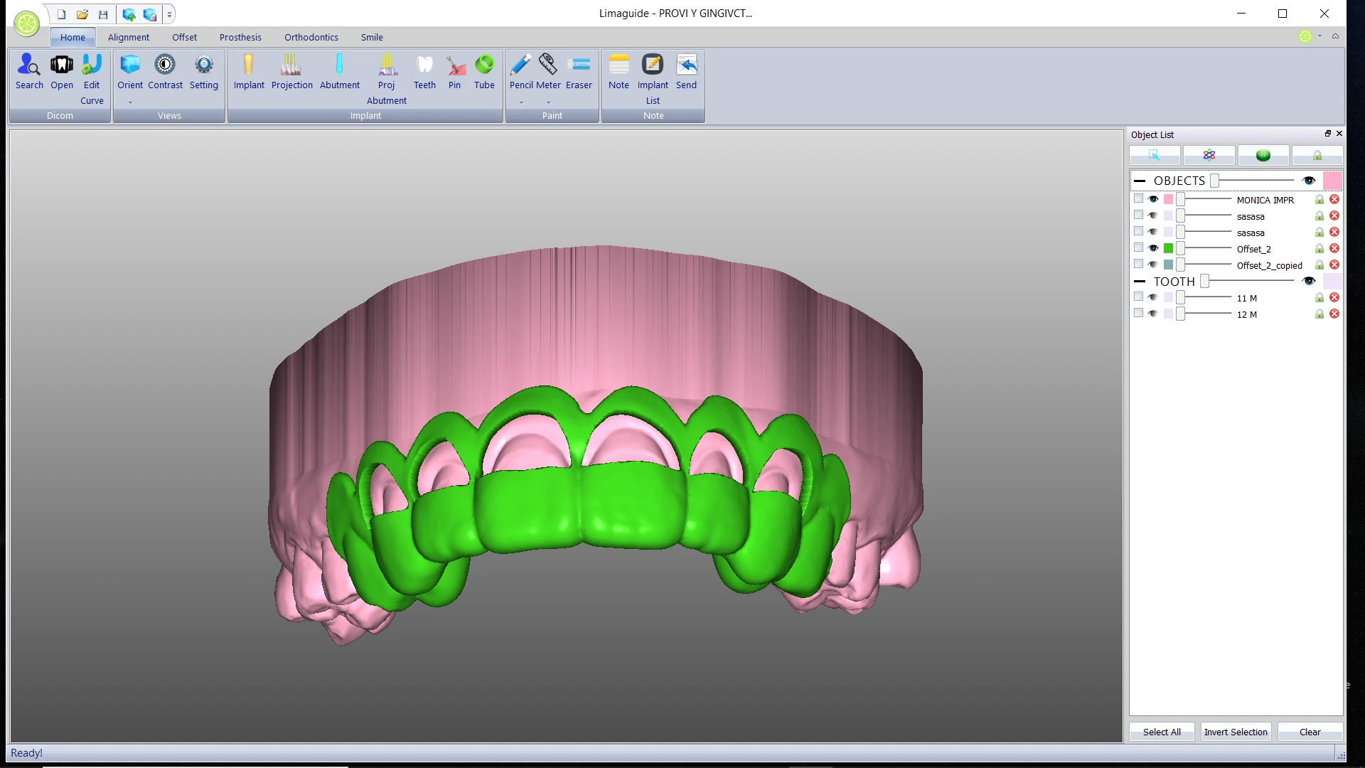 Guía de Gingivectomía Digital para Alargamiento Coronario