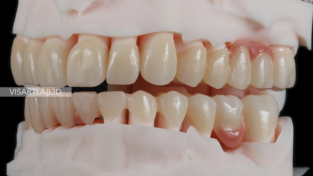 Rehabilitación Posterior con Zirconia Monolítica